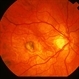 Myopic CNV Myopic CNV